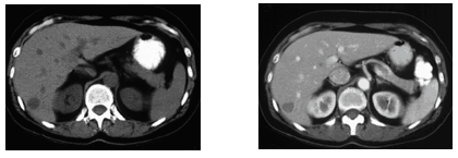 Conventional CT scan without contrast showing possible tumor in the liver, and a conventional CT scan of the same patient using contrast.