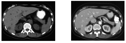 Cancers That Show Up On CT Scans