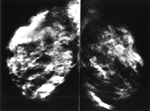 Conventional mammography