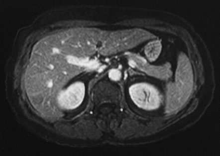 MRI with contrast