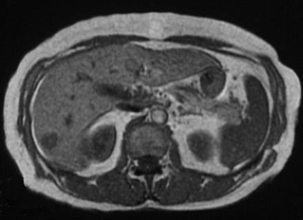 MRI without contrast