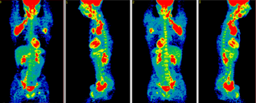 PET scan