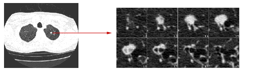 A 1 mm spiral CT slice, and a close-up view of 8 slices