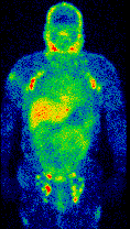 SPECT scan